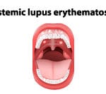 types of lupus