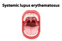 types of lupus