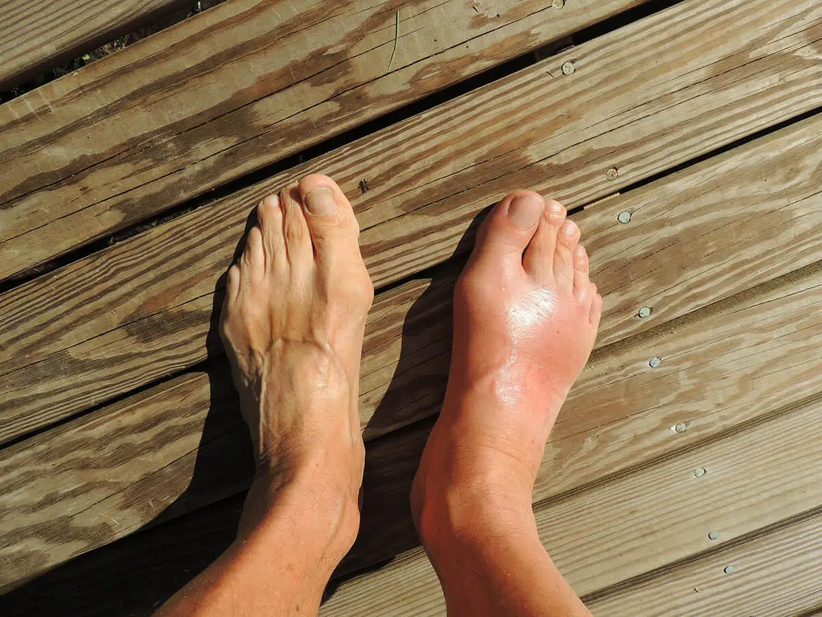 Gout Treatment in Dubai, UAE?